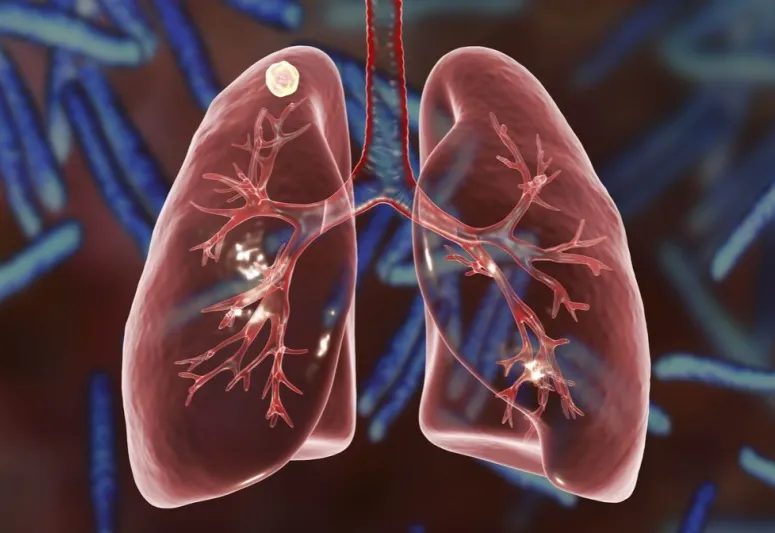 Itapetininga inicia Campanha “Fique Sabendo Tuberculose 2026” com busca ativa e oferta de exame