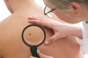 Prorrogada data de inscrições para realizar exame de Câncer de Pele