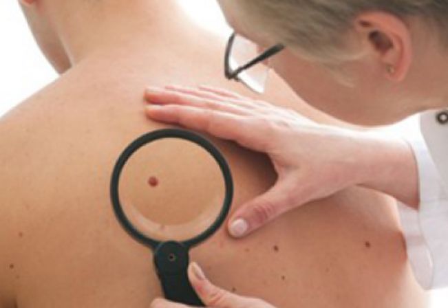 Prorrogada data de inscrições para realizar exame de Câncer de Pele